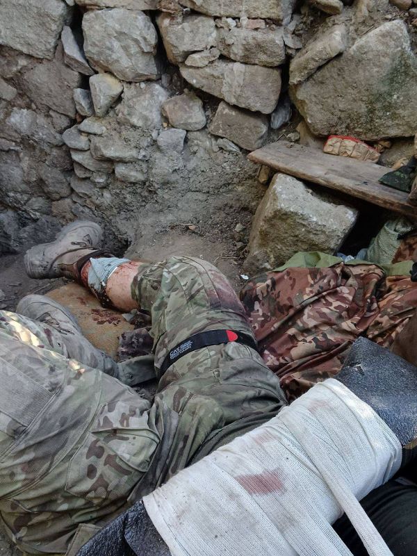 Один из основных нюансов в пользу турникета , это возможность наложения одной рукой на нижнюю конечность .. в данном случае у нашего товарища было ранение верхней и нижней конечности, и успешное наложения турникета на ...