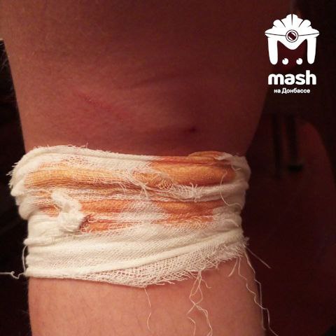 Разъяренные бродячие собаки прокусили ноги девочке из Алчевска