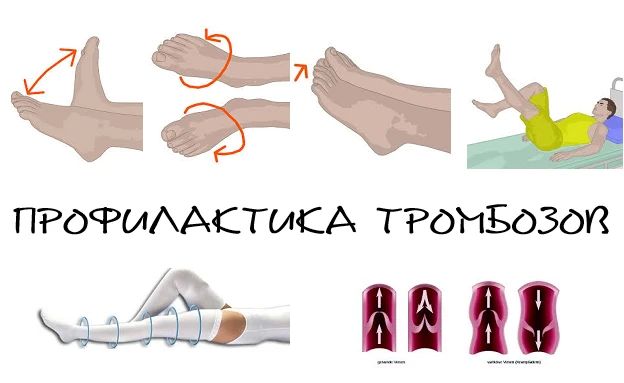 Тромбоз: невидимая угроза и как от неё защититься Тромбоз: невидимая угроза и как от неё защититься